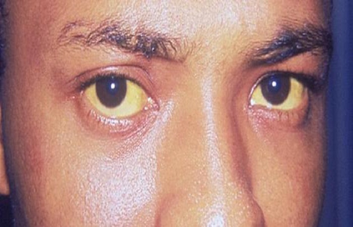 9 مشاكل صحية وراء اصفرار العين عند البالغين