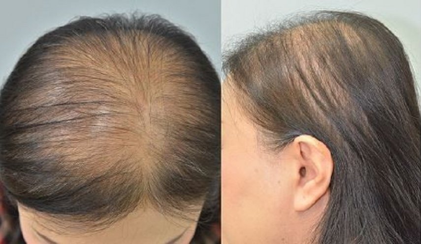 علاج التساقط.. الكشف عمّا يساعد في زيادة نمو الشعر!